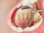 Karang gigi Como quitar el sarro de los dientes