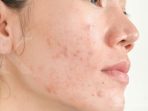 Kulit Wajah Kaku Setelah Pakai Obat Jerawatan Review