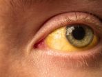soflens
